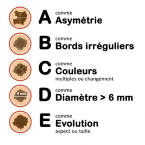 ABCDE grains de beaute