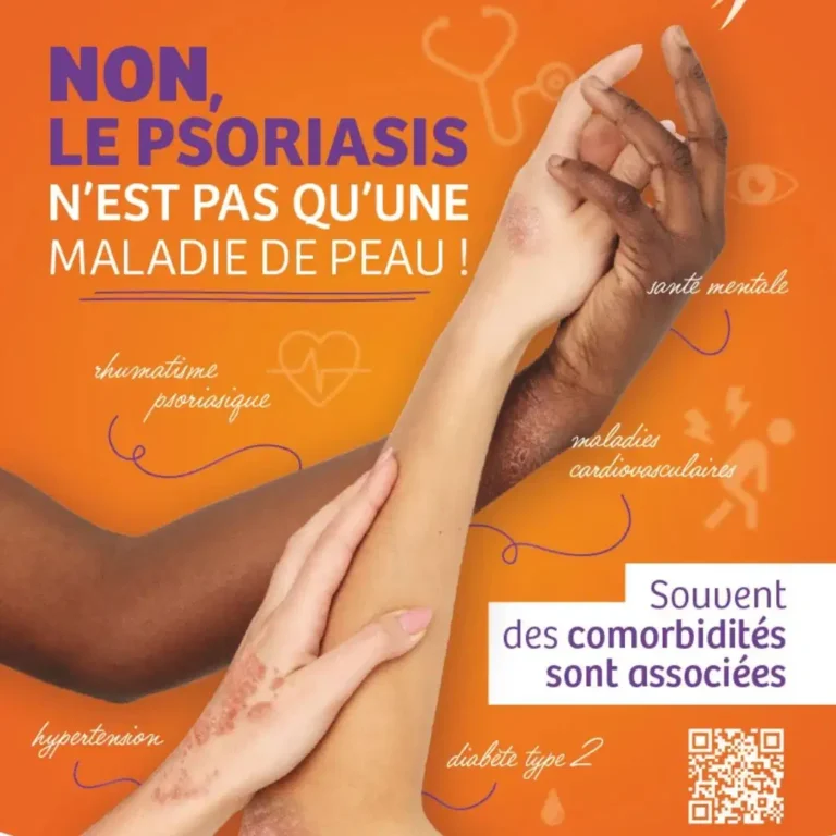 psoriasis